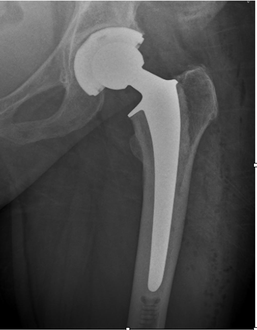 Left Hip Raplacement X Ray