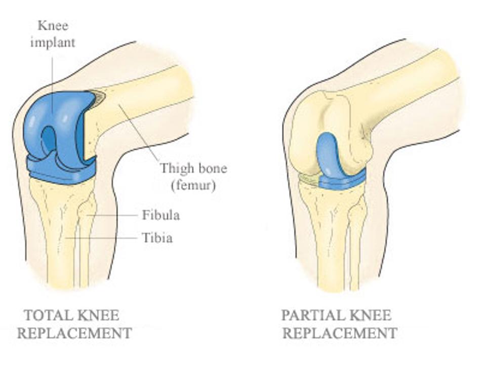 Total And Partial Knee Replacement