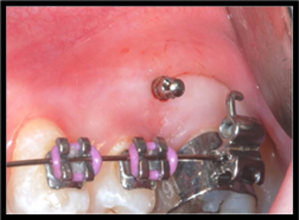 Mini Screws