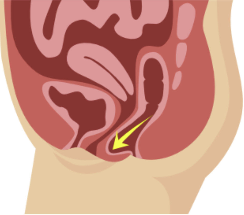 Back Vaginal Wall Prolapse