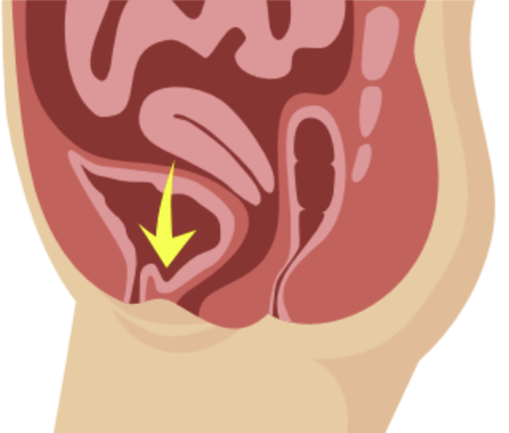 Front Vaginal Wall Prolapse