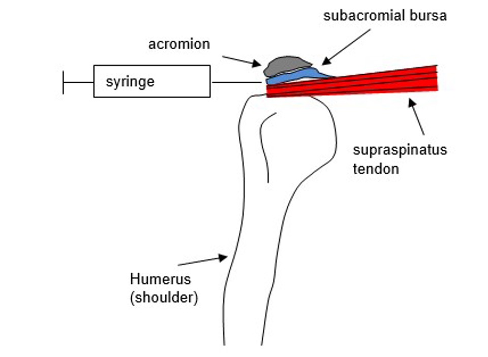 Shoulder Injection Into Subacromial Space