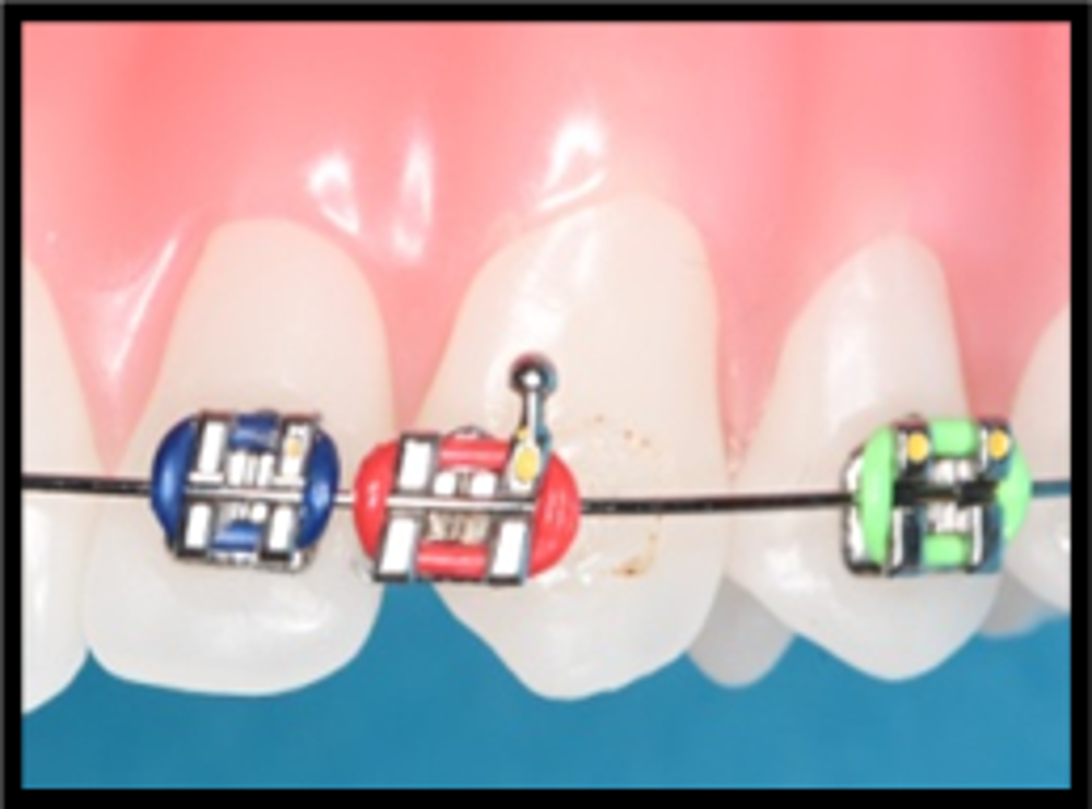 Brackets