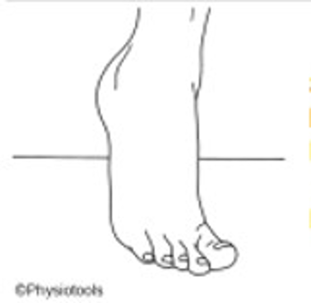 4. Intrinsic Foot Exercises
