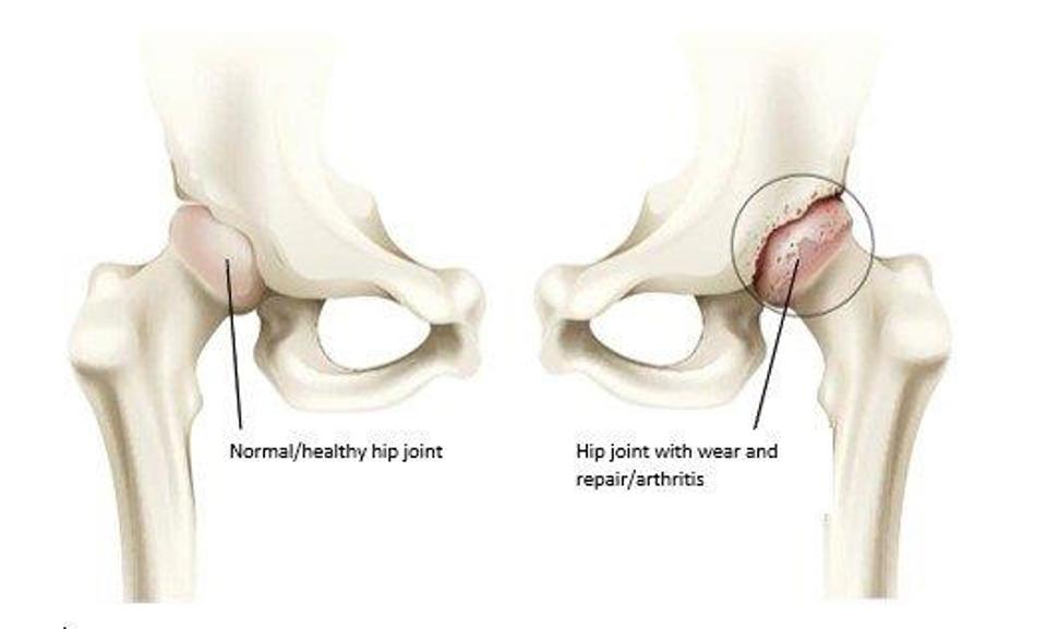 Normal Hip Joint And One With Wear And Tear