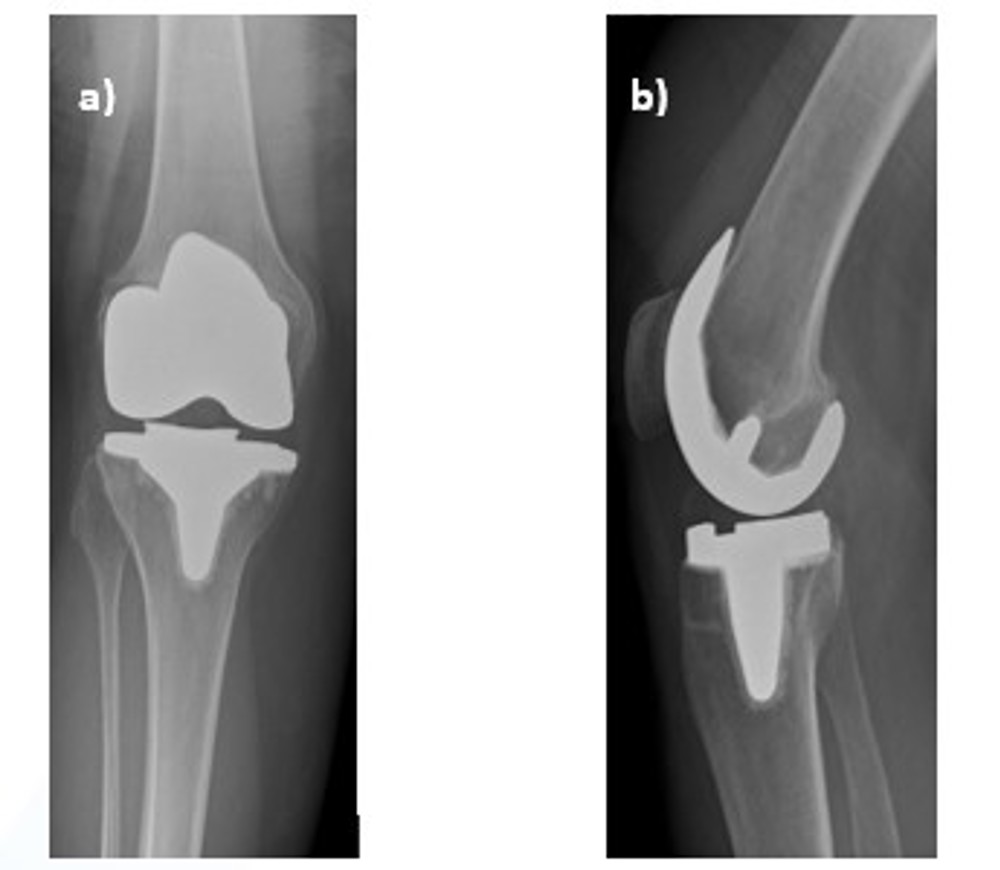 Knee Joint From The Front And Side