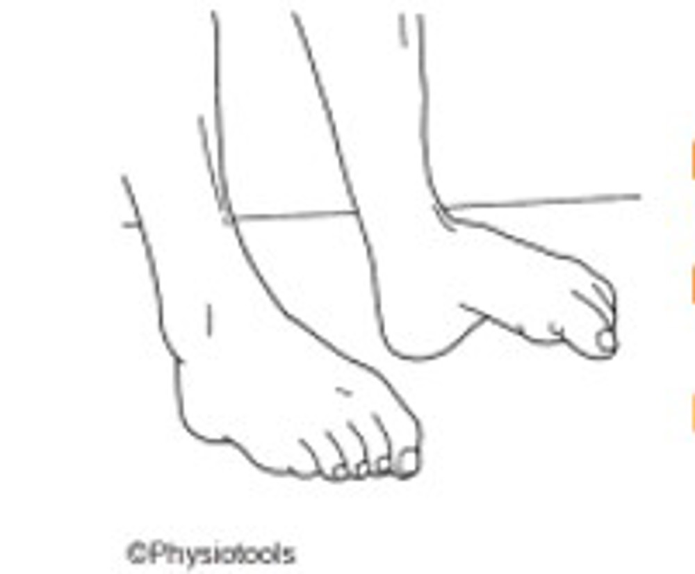 5. Intrinsic Foot Exercises