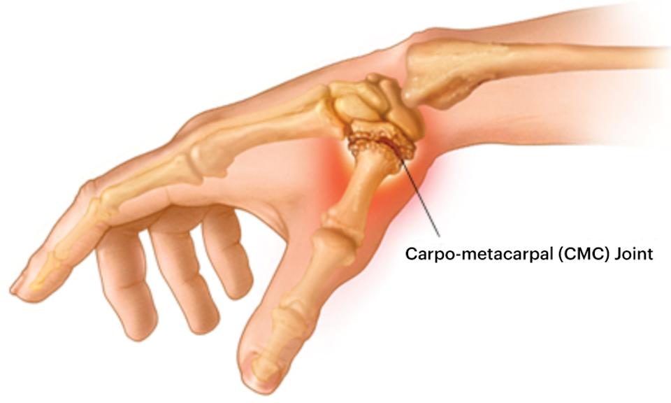 Carpo Metacarpal (CMC) Joint