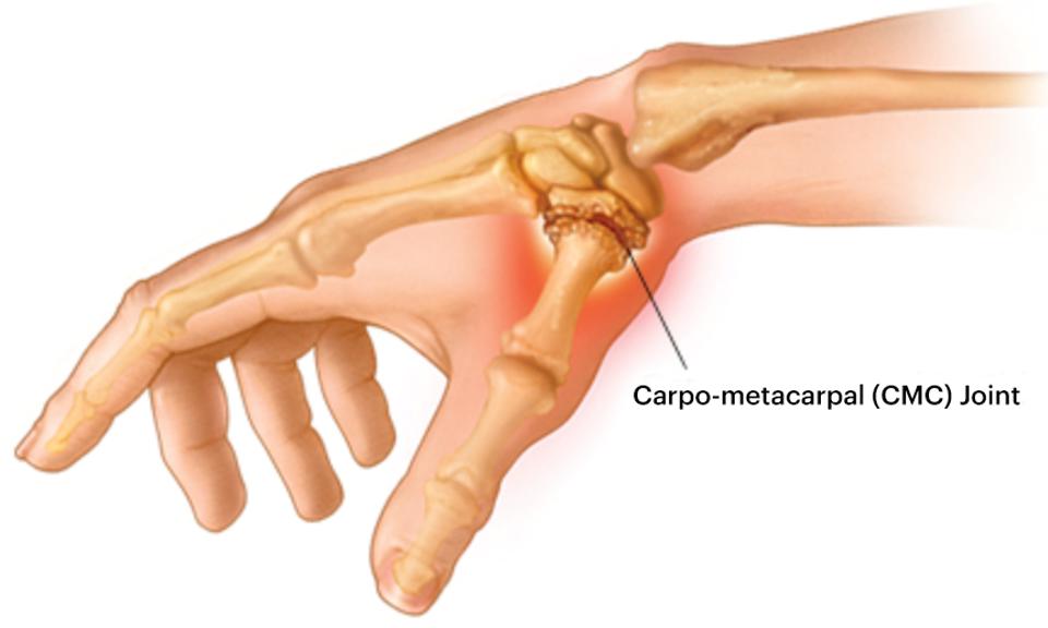 Carpo Metacarpal (CMC) Joint