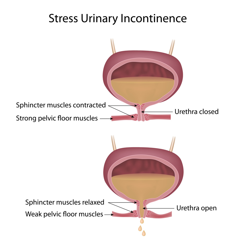 Stress urinary incontinence showing the urethra closed and open