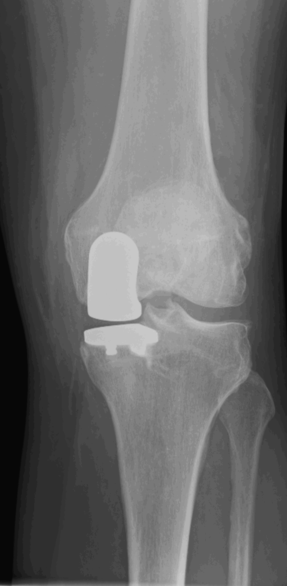 Knee Partial Replacement