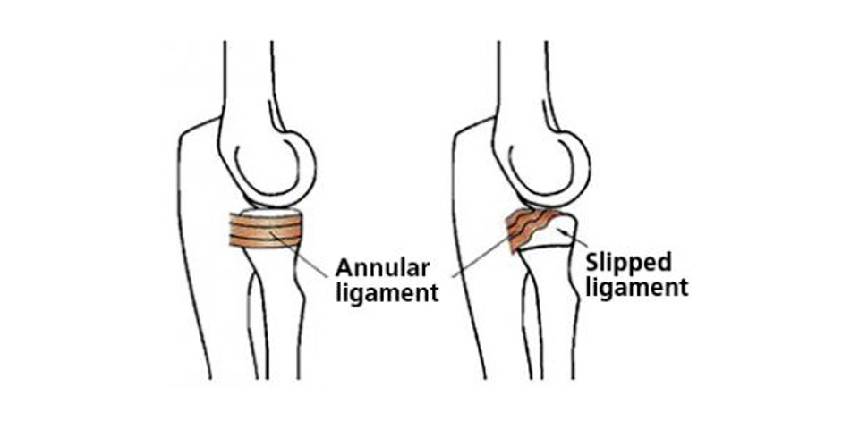 Pulled Elbow Diagram