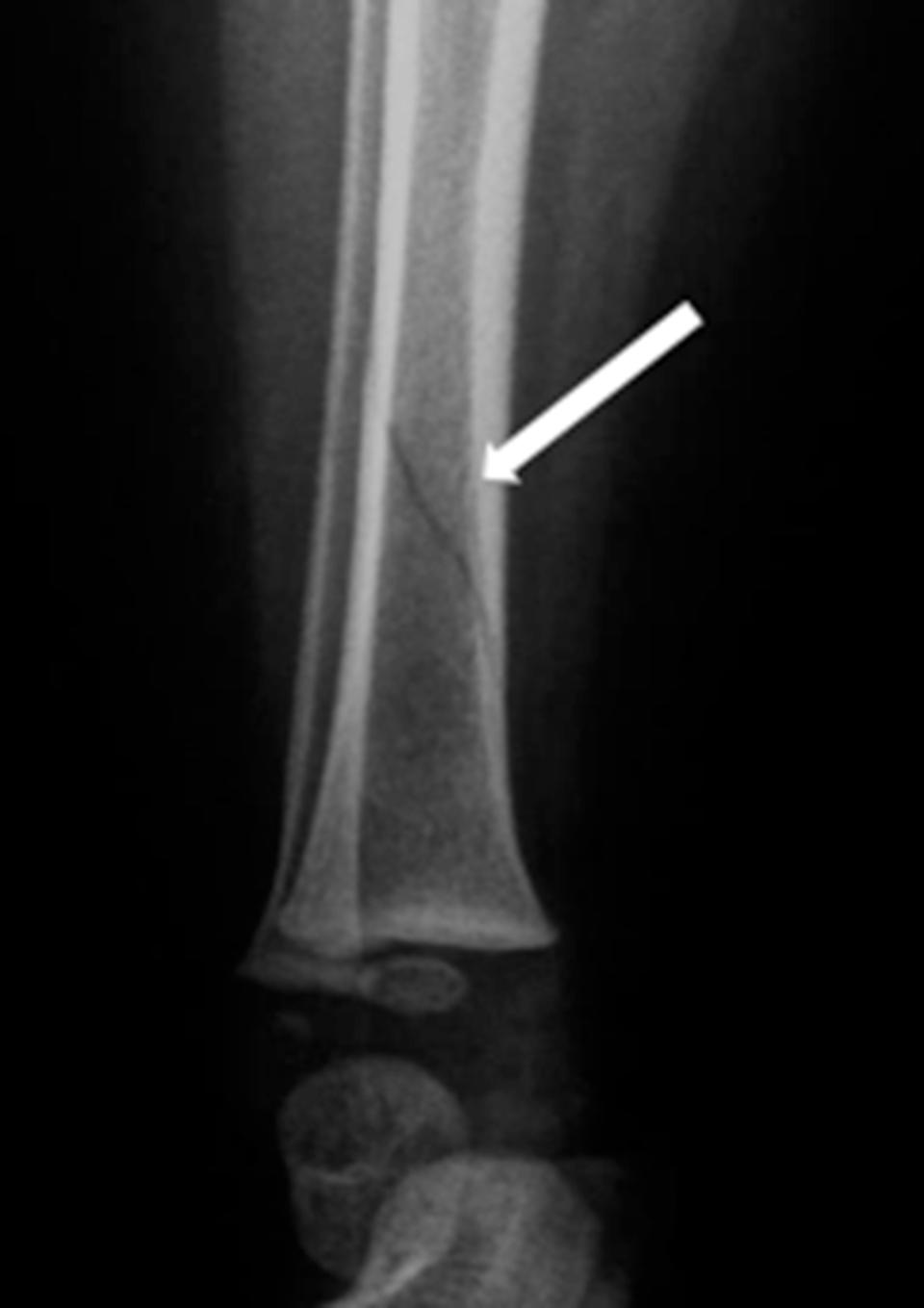 Toddler Fracture