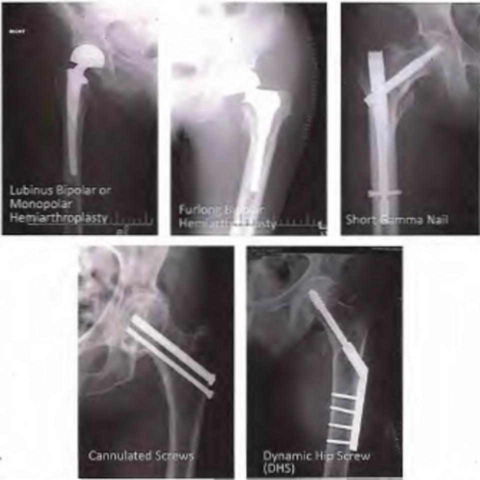 X-rays of hip bones
