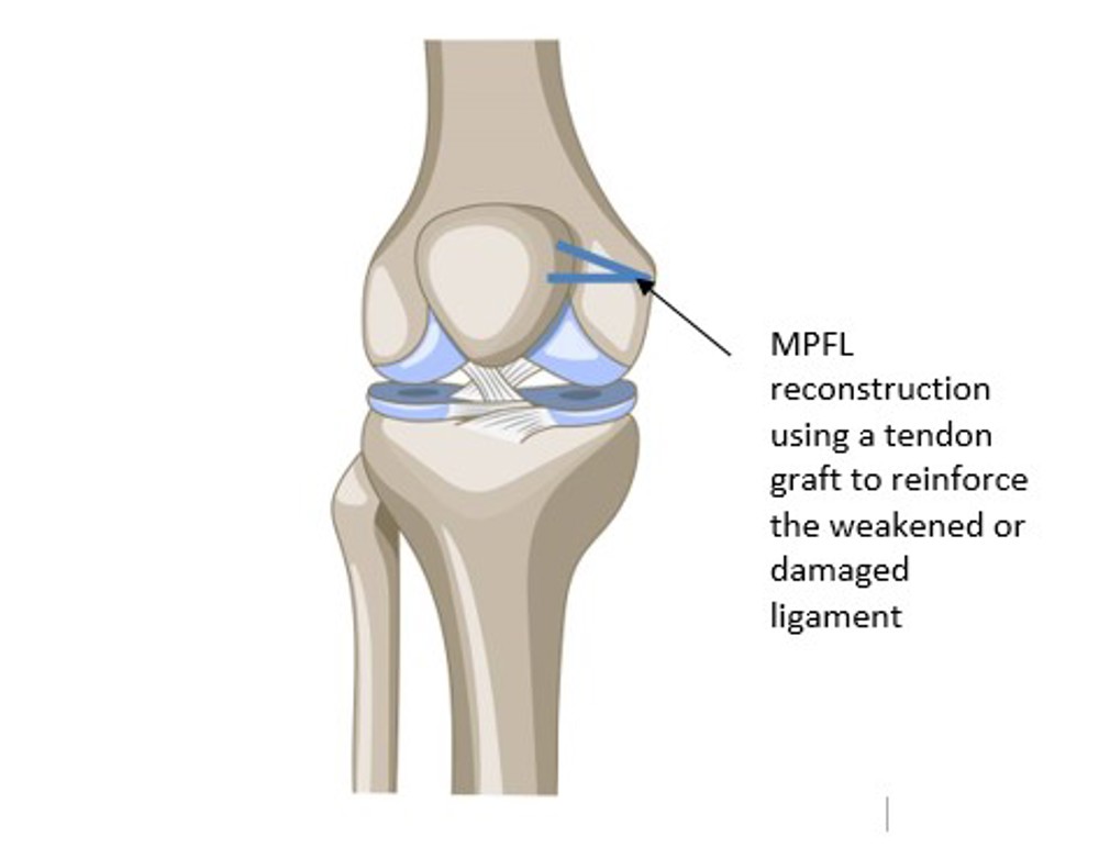 MPFL reconstruction using a tendon graft to reinforce the weakened or damaged ligament