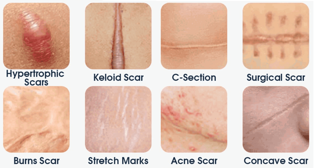 Scars