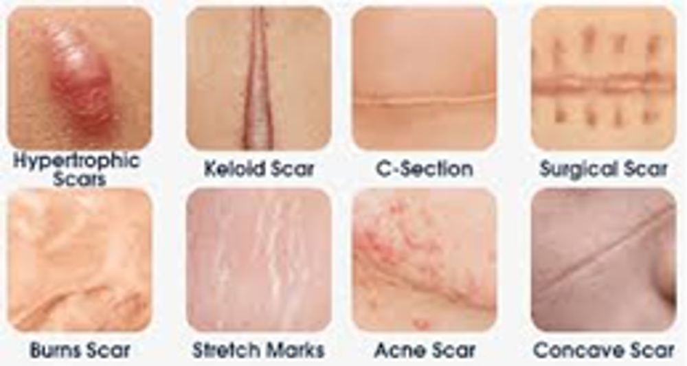 Scars
