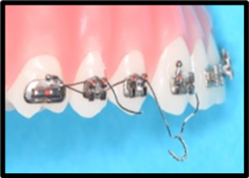 Long Wire Ligatures