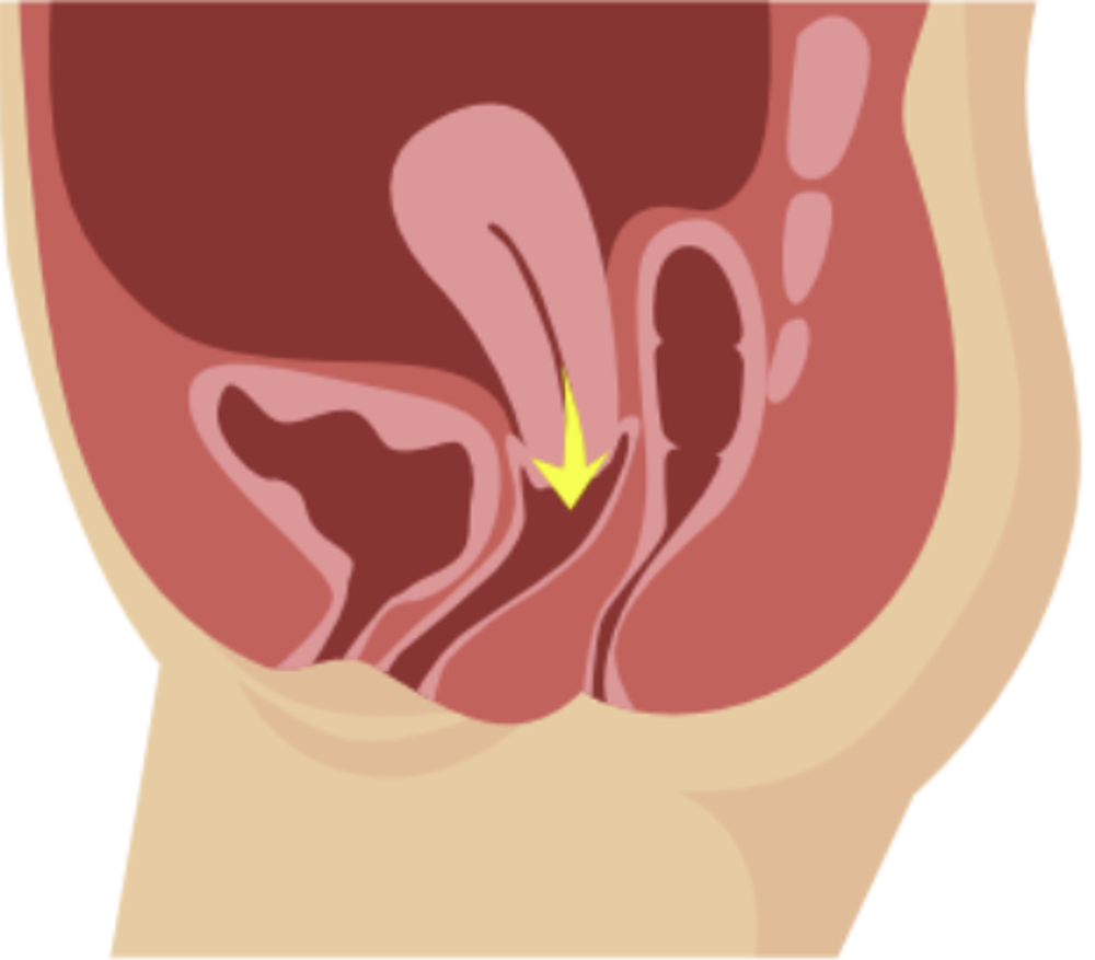 Uterine Prolapse