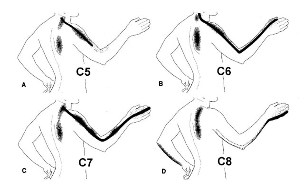 Cervical Referred Pain Patterns