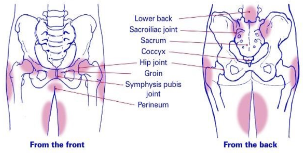 Pregnancy Related Pelvic Girdle Pain Diagram