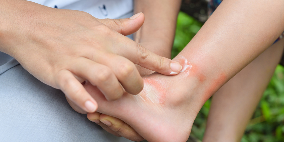 Rubbing cream on an ankle insect bite