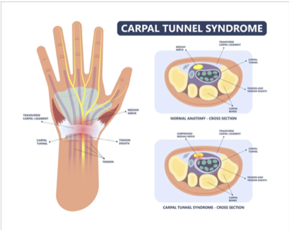 Carpal Tunnel Sydrome Diagram