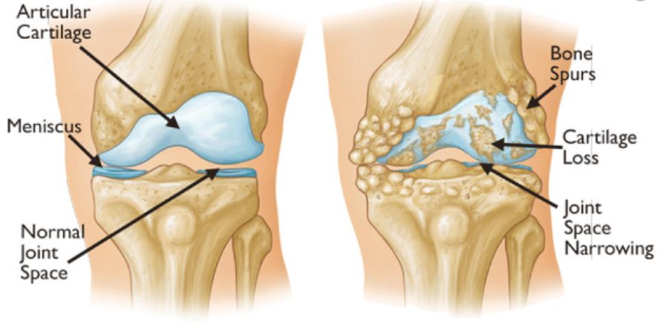 Healthy And Arthritic Knee Joint