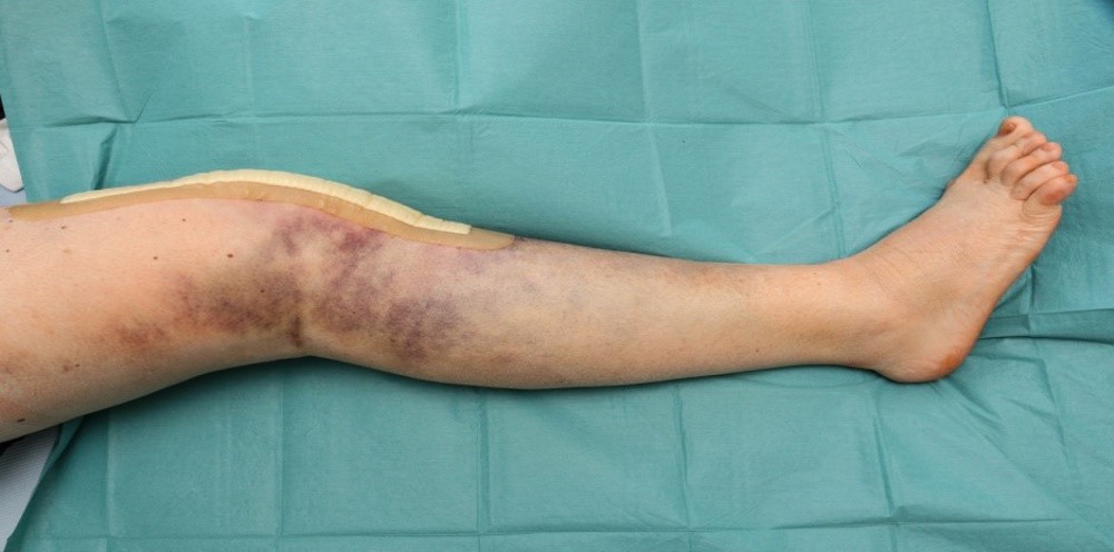 Bruising and swelling around leg wound with dressing