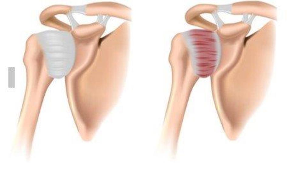 Normal Shoulder And Frozen Shoulder