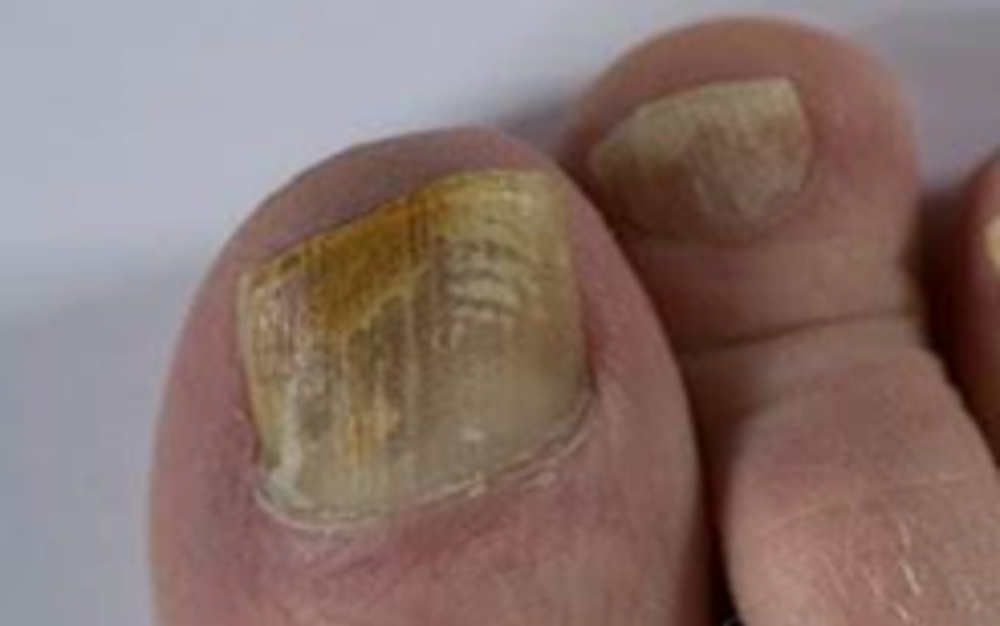 Fungal Nail