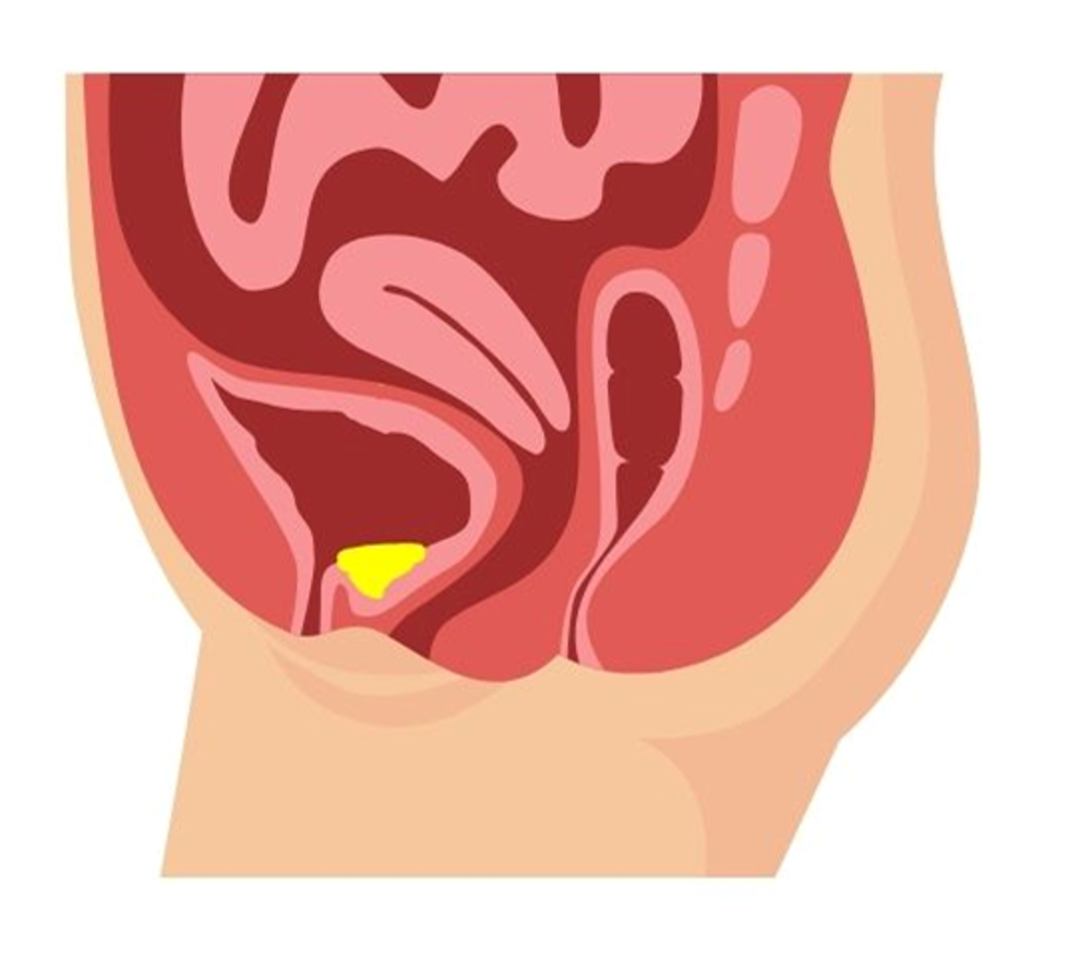 Incompete Bladder Emptying